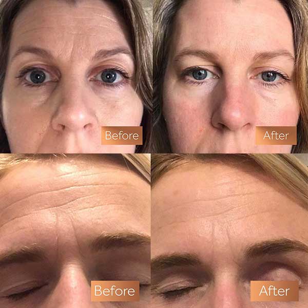 سرم دور چشم کافئین اوردینری