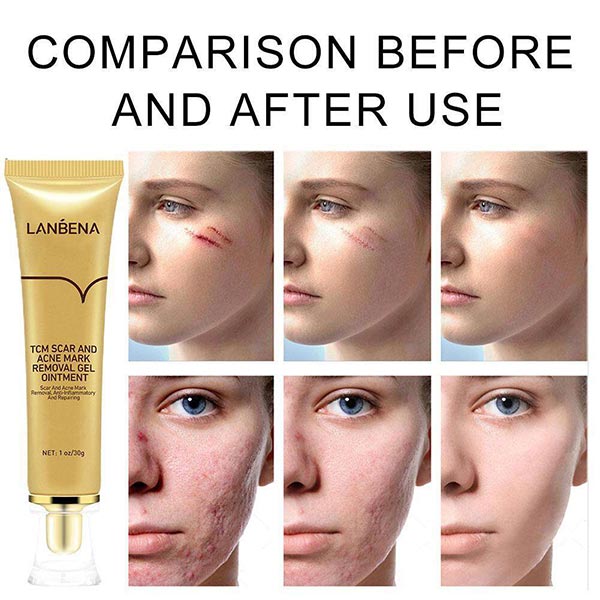 ژل کرم ترمیم کننده اسکار لانبنا (Lanbena Skin Care Gel)