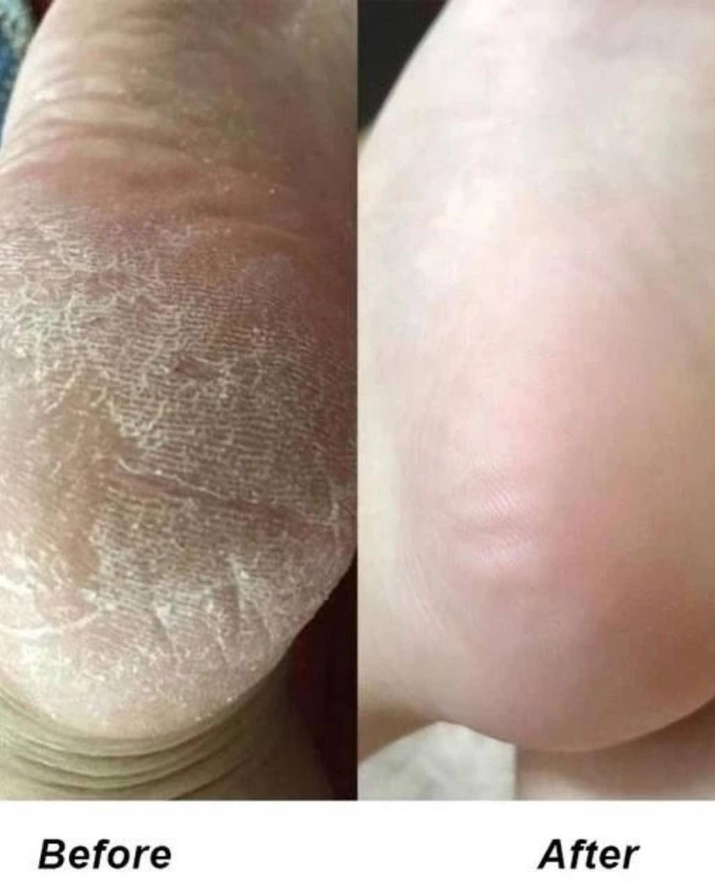 اسپری رفع ترک پا راکو (رایحه رندوم)