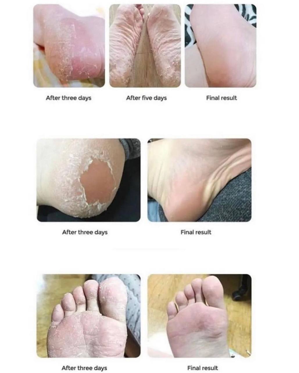 اسپری رفع ترک پا راکو (رایحه رندوم)