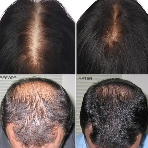 قرص هیرتامین آمریکا