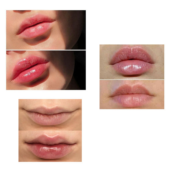 حجم دهنده ی لب کاریته