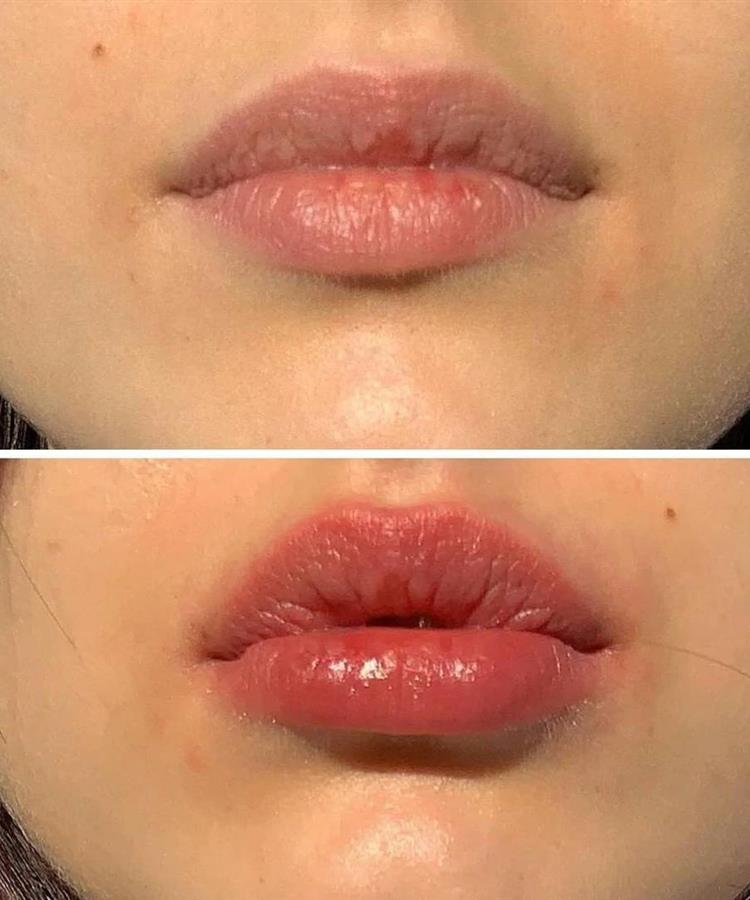 حجم دهنده ی لب کاریته