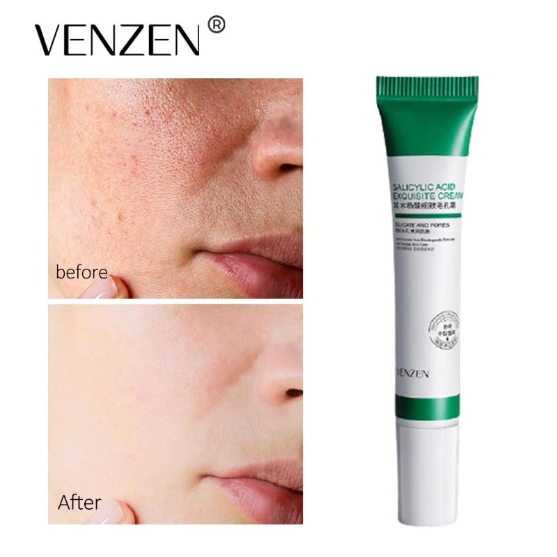 کرم ضد جوش وزه مدل سالیسیلیک اسید حجم 20 میلی لیتر