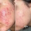 سرم آزلائیک اسید آنوا حجم 30 میل